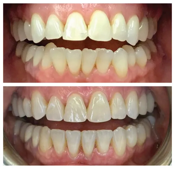 Before and after cosmetic dental treatment showing improved tooth shape, alignment, and smile aesthetics