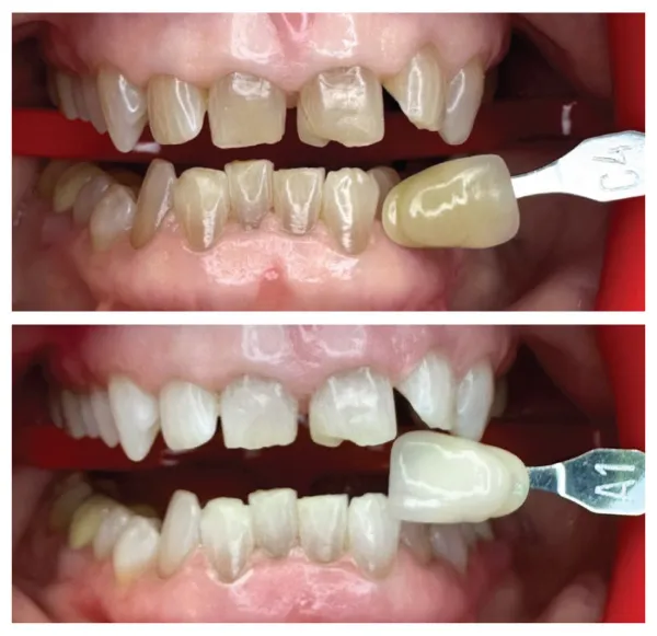 Before and after dental veneer shade matching procedure improving tooth color and appearance