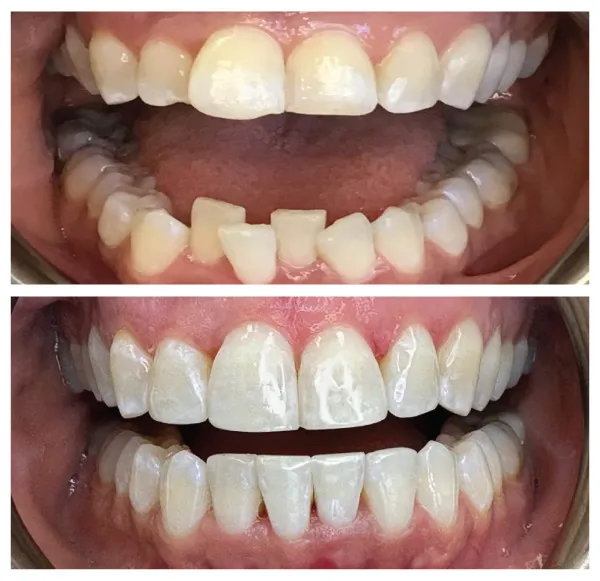Before and after restorative dental treatment replacing missing front teeth and restoring smile function