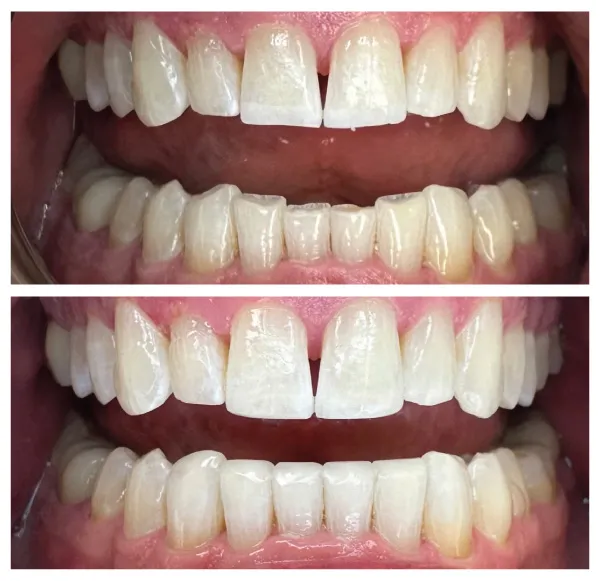 Before and after smile makeover treatment improving tooth symmetry and overall dental aesthetics