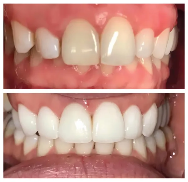 Before and after cosmetic dentistry treatment correcting chipped and uneven front teeth
