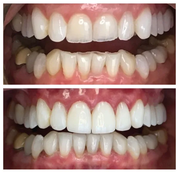 Before and after orthodontic and cosmetic dental treatment improving tooth alignment and bite