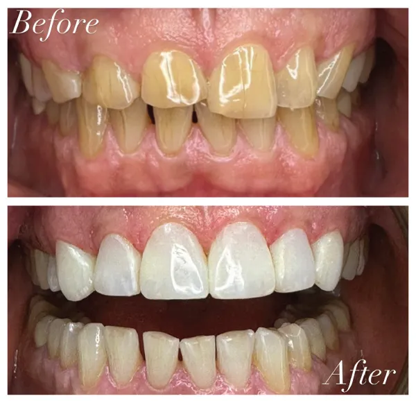 Before and after restorative dental treatment correcting severe discoloration and damaged teeth