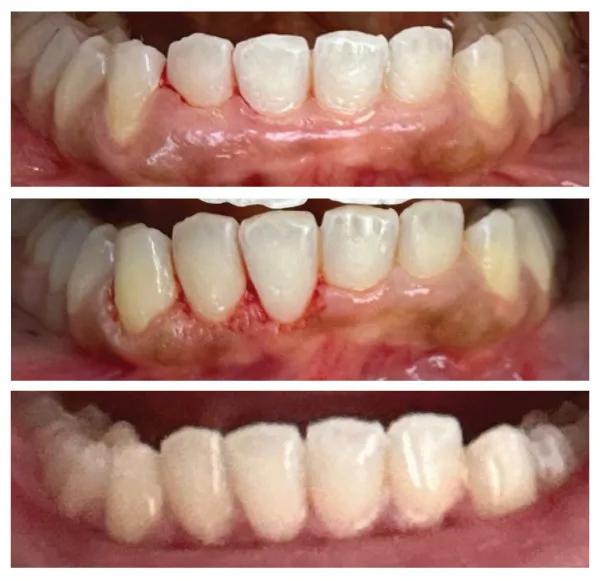 Before and after cosmetic dental bonding treatment restoring chipped front teeth