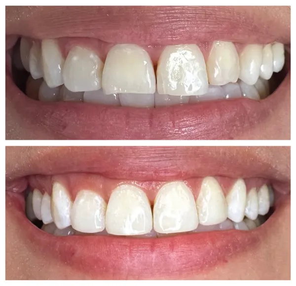 Before and after periodontal and restorative dental treatment improving gum health and tooth appearance