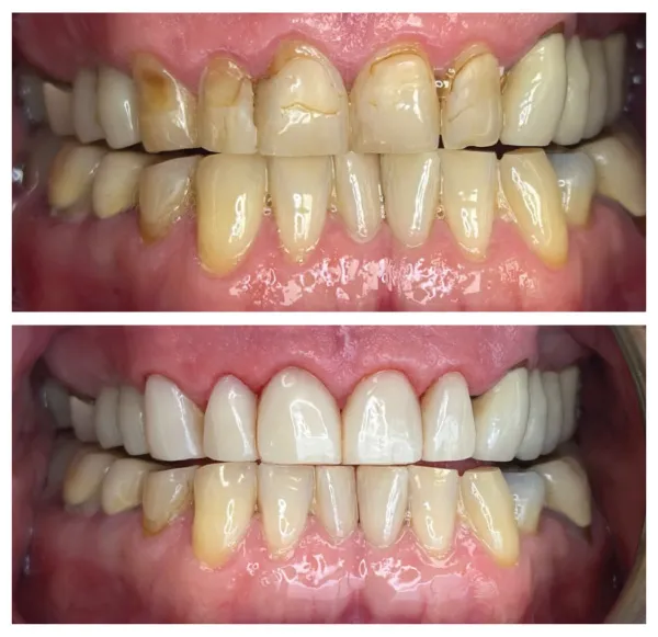 Before and after cosmetic dentistry treatment brightening teeth and improving smile aesthetics