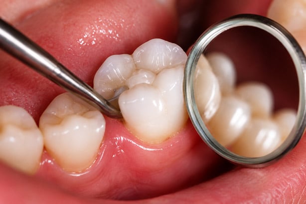 Close-up of dental examination and oral care during routine treatment