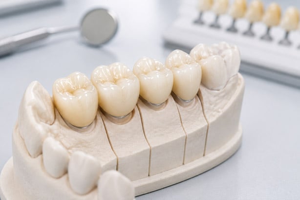Dental crowns prepared for restorative dental treatment