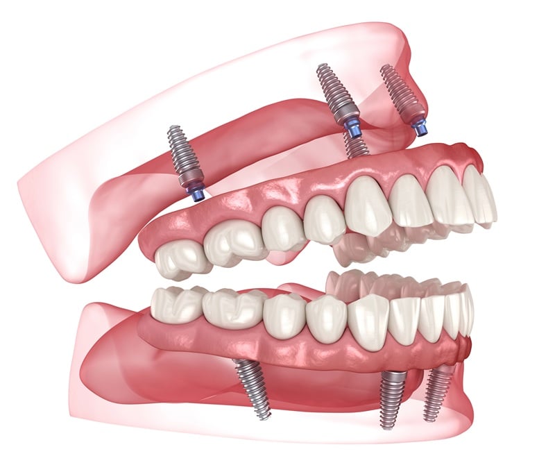 Illustration of All-on-X dental implants supporting a full arch restoration