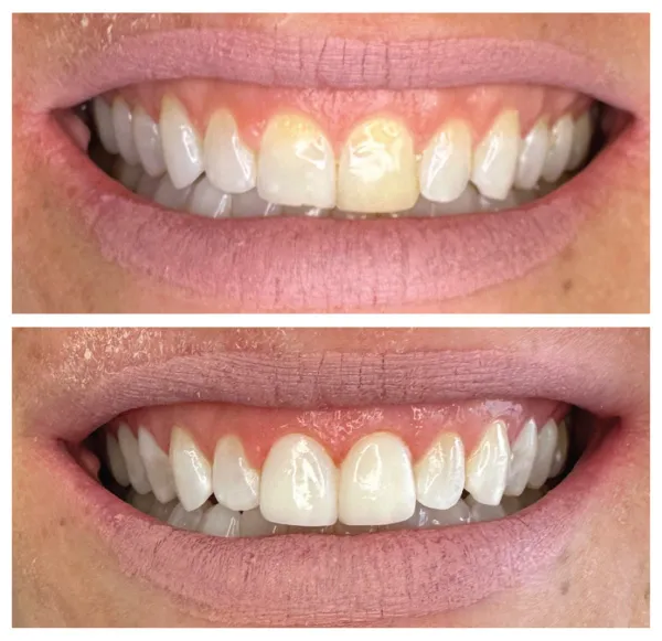 Before and after cosmetic dentistry treatment brightening teeth and improving smile aesthetics