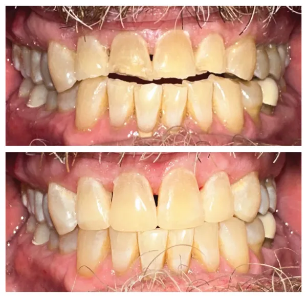 Before and after dental treatment results showing improved tooth alignment and smile appearance