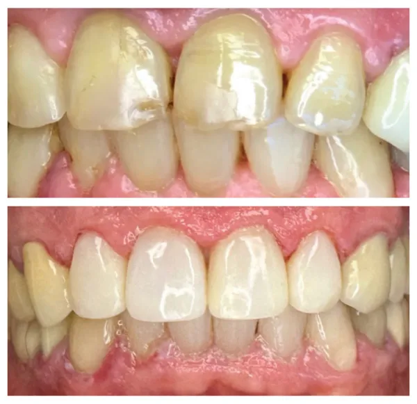 Before and after cosmetic dentistry treatment correcting tooth discoloration and uneven spacing