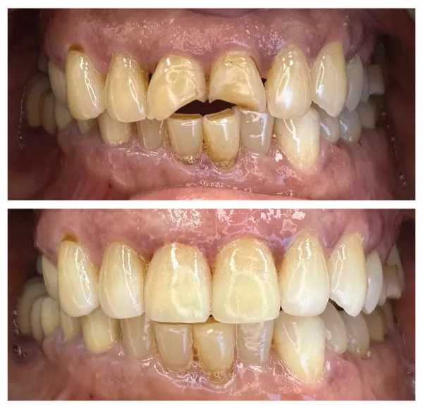 Before and after restorative dental procedure improving damaged and misaligned teeth