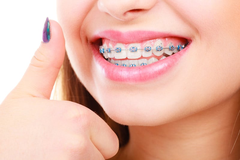 Teenager smiling with metal braces during orthodontic treatment