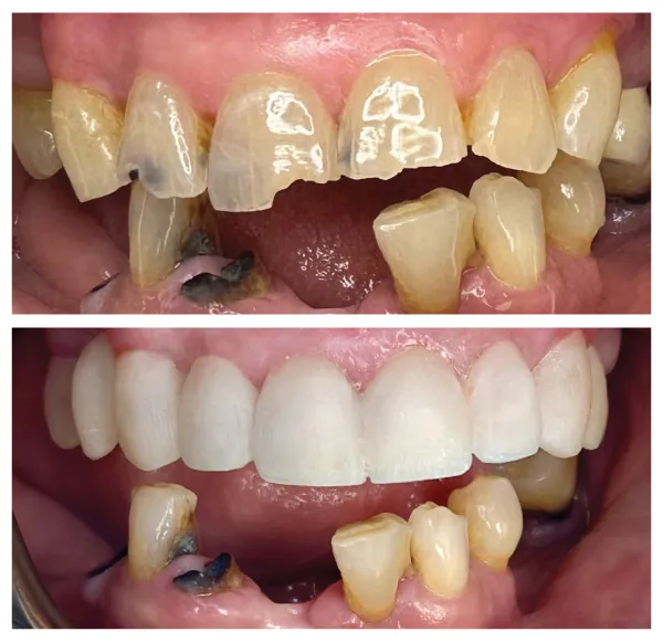 Before and after restorative dental treatment replacing missing and damaged teeth