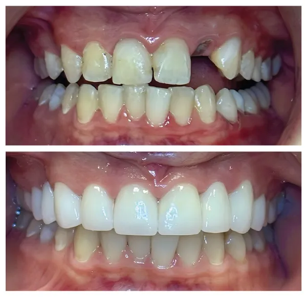 Before and after cosmetic dental treatment enhancing smile symmetry and tooth color