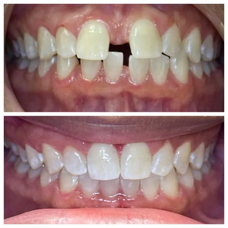 Before and after dental treatment correcting crowded and overlapping front teeth