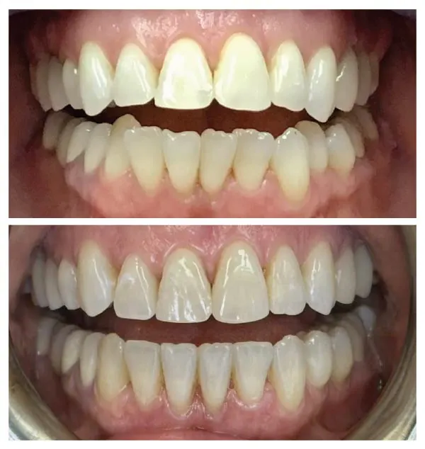 Before and after cosmetic dental treatment showing improved tooth shape, alignment, and overall smile aesthetics