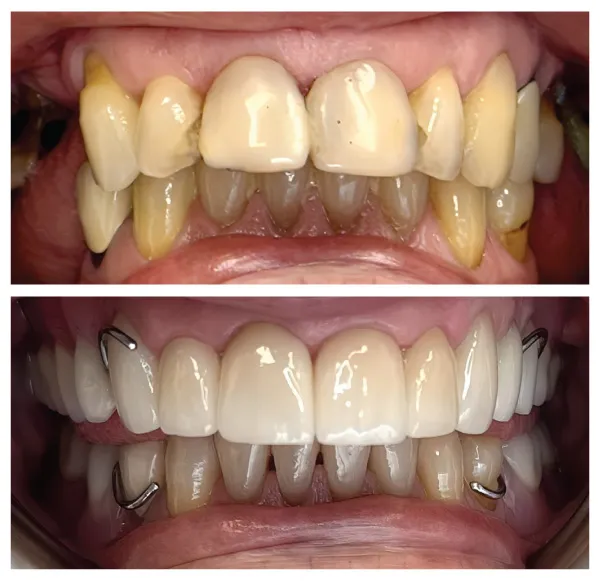 Before and after restorative dental care improving severely worn and damaged teeth