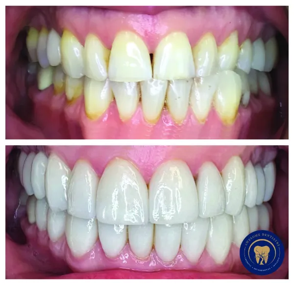 Before and after cosmetic dentistry treatment with significantly whiter and straighter teeth