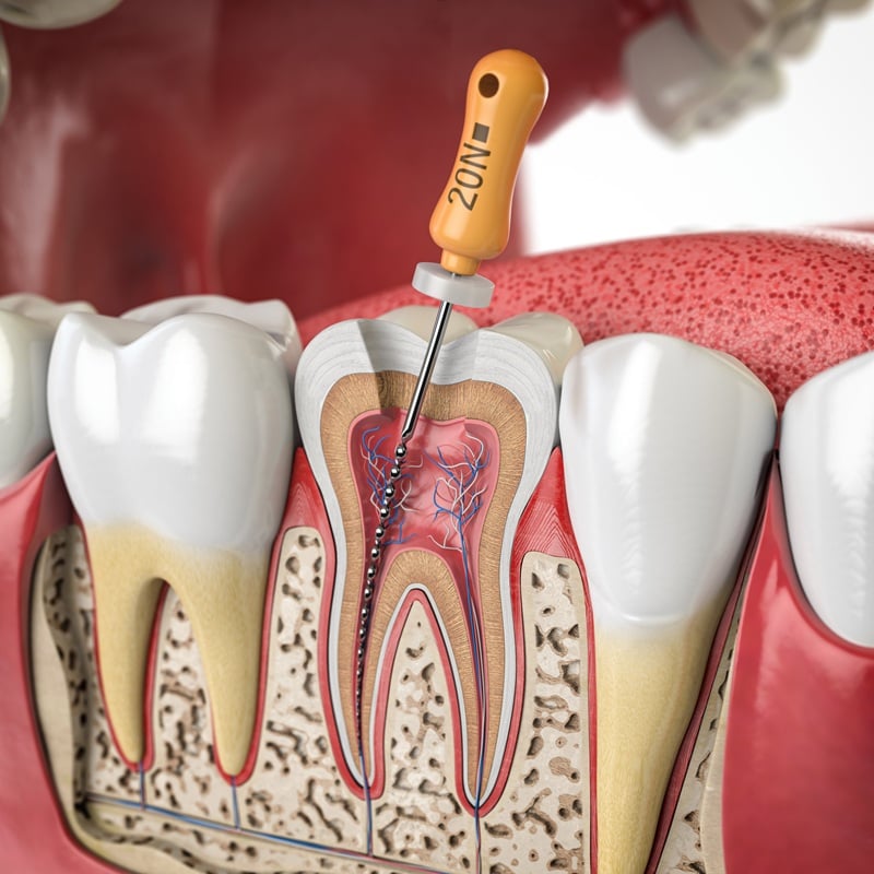 Illustration of root canal therapy procedure showing infected tooth pulp and dental treatment