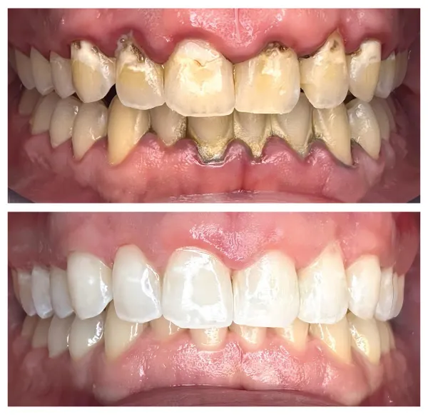 Before and after cosmetic dental bonding improving chipped and uneven teeth