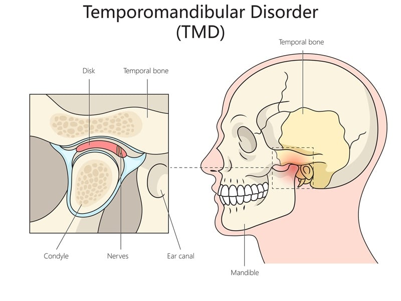 Medical illustration showing temporomandibular joint disorder and jaw anatomy