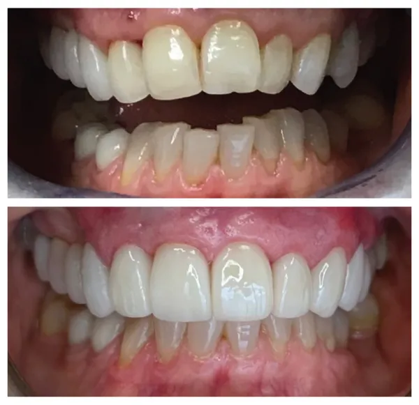 Before and after dental treatment resulting in a brighter and more symmetrical smile