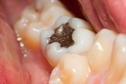 Close-up of dental filling treatment restoring a decayed tooth