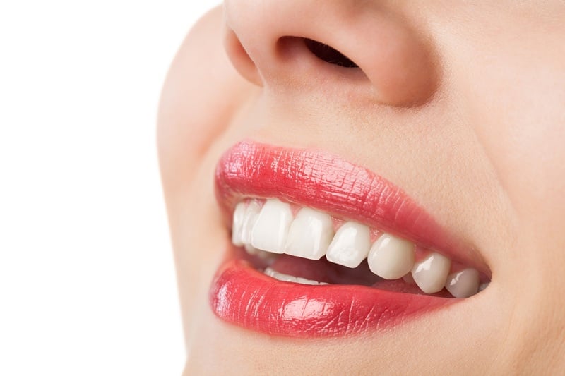 Close-up of smile with clear braces used for orthodontic treatment