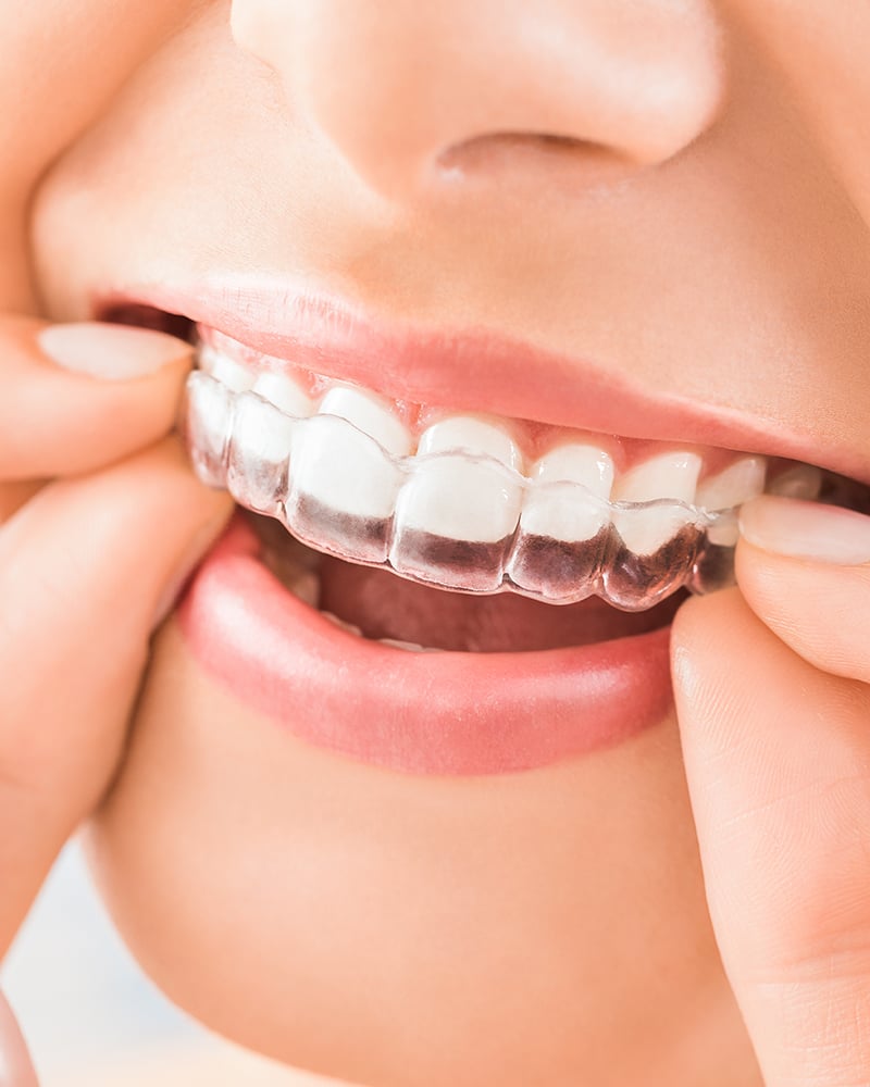 Close-up of Invisalign clear aligners being placed over teeth