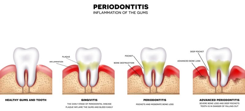 Illustration showing stages of periodontal disease and gum recession treatment